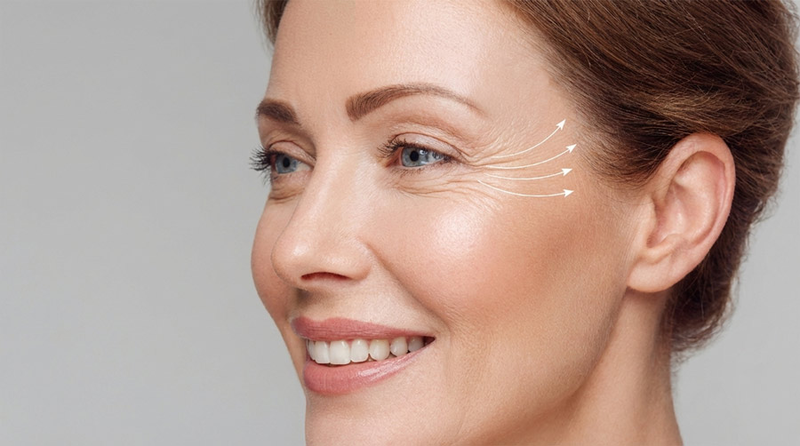 Augenlachfalten (Krähenfüße) behandeln in Berlin